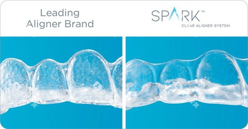 Spark精靓隐形矫正器通透度更高