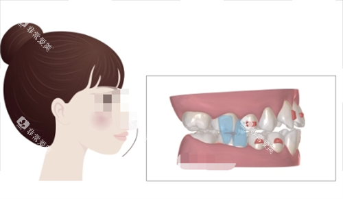 正雅隐形矫正S8突面矫正展示