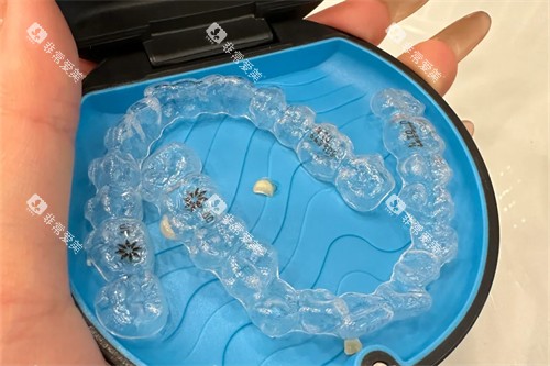 美国隐适美隐形矫正牙套