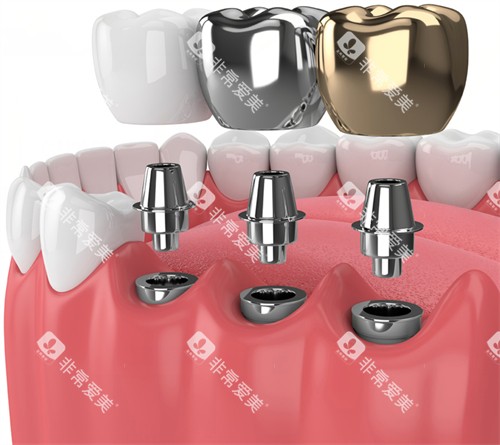 种植牙动画示意图展示