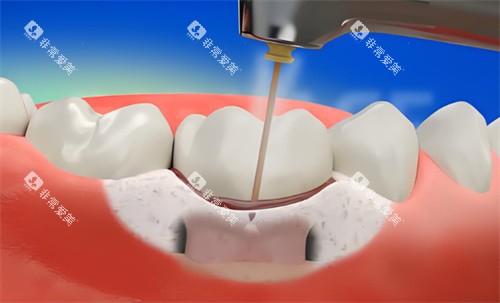 牙周炎激光治疗