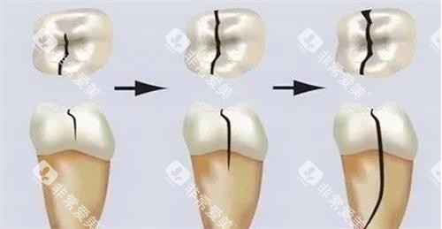 牙齿裂纹的发展过程