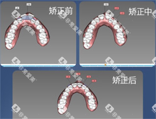 牙齿矫正设计图