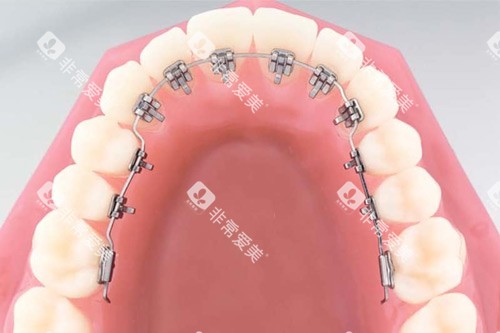 舌侧矫正示意图