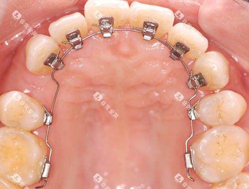 舌侧矫正细节图