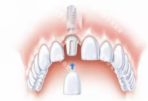 种植牙的种植部位 种植牙的种植部位