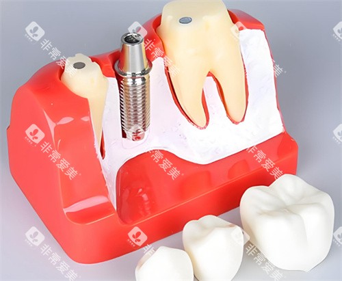 牙齿模型种植体