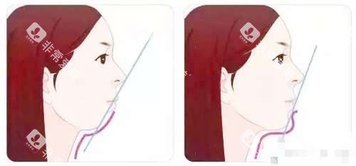 深覆合矫正前后脸型对比图