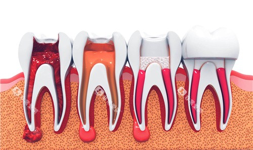 牙科根管治疗过程图 牙科根管治疗过程图