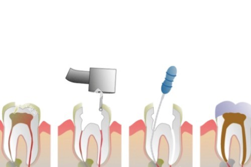 根管治疗卡通步骤图 根管治疗卡通步骤图
