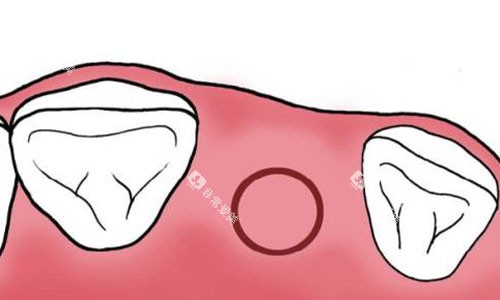 根管治疗切口 根管治疗切口