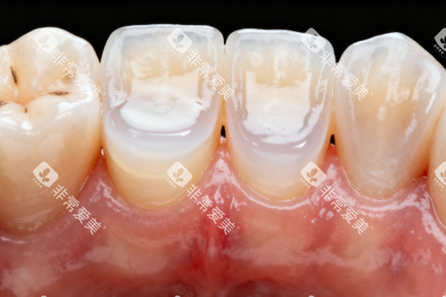 牙齿发黄图片展示 牙齿发黄图片展示