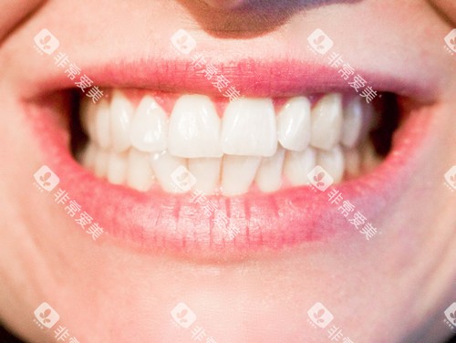 整齐的牙齿 整齐的牙齿