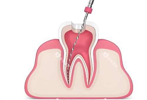 根管治疗卡通展示 根管治疗卡通展示