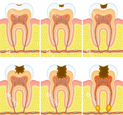 需要根管治疗的牙齿 需要根管治疗的牙齿