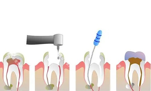 根管治疗过程的示意图