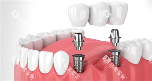 在口腔内进行种植牙