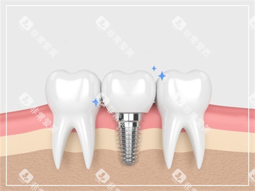 种植牙与真实牙齿漫画示意图
