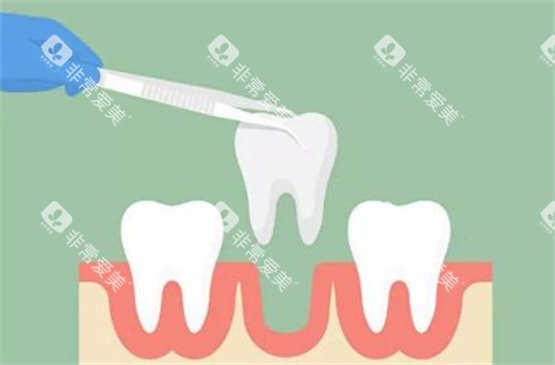 牙齿拔除改善图