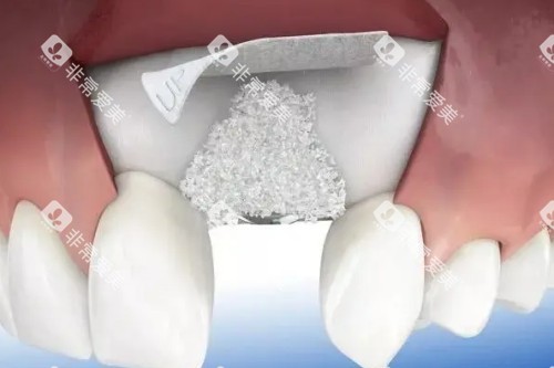 种植牙植骨卡通展示图