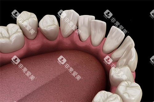 牙齿不整齐内侧视角 牙齿不整齐内侧视角