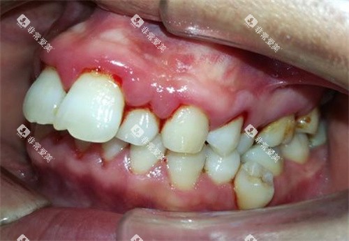 牙周炎照片