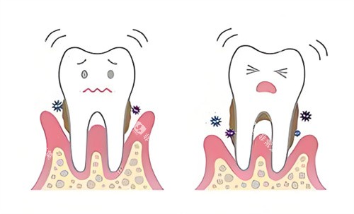 牙周炎卡通图片