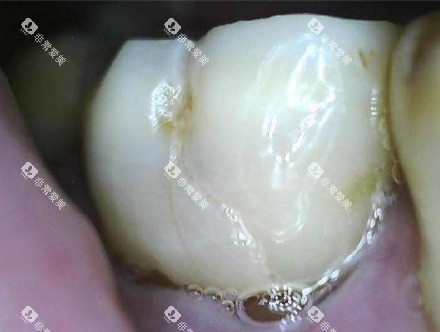 牙周炎症照片 牙周炎症照片