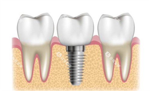 种植牙周围健康牙 种植牙周围健康牙