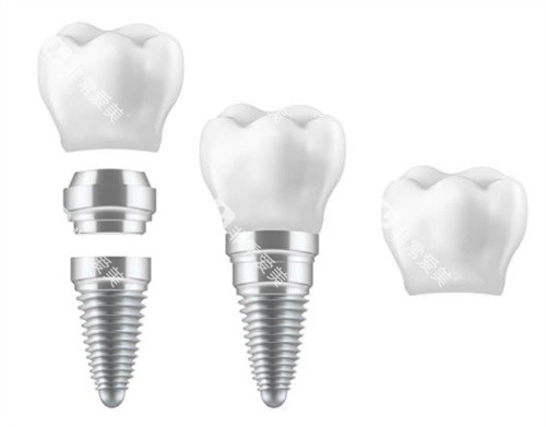 种植牙的各个部分 种植牙的各个部分