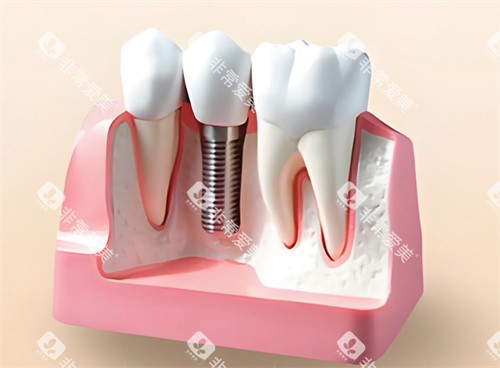 种植牙模型解剖展示 种植牙模型解剖展示