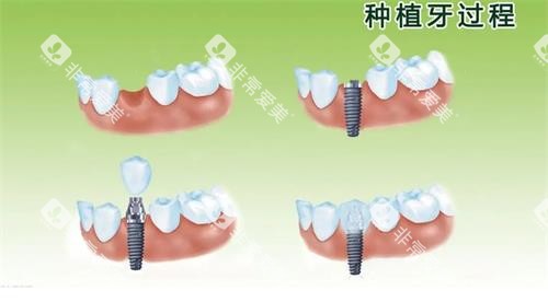 种植牙的过程 种植牙的过程