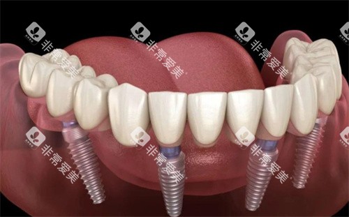 全口种植牙