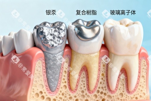 补牙材料卡通图展示