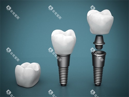 种植牙结构展示