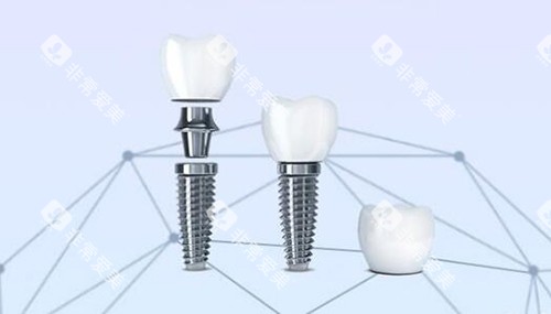口腔种植牙改善