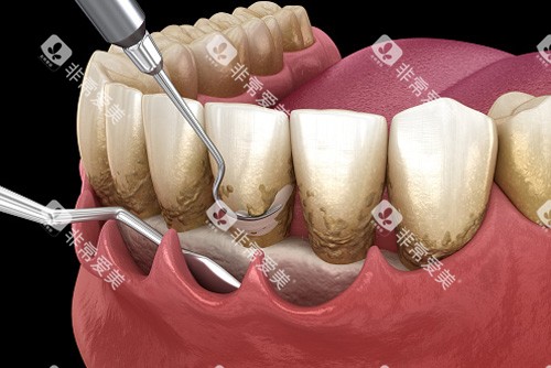 牙龈刮治卡通图 牙龈刮治卡通图