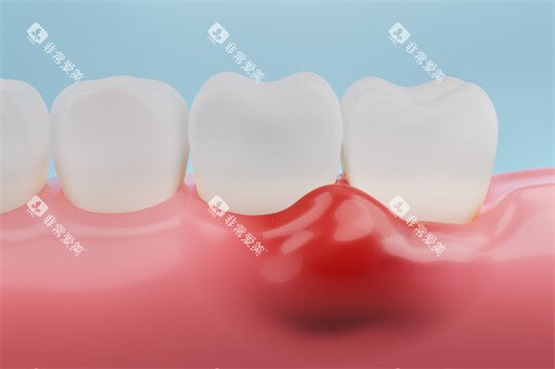 牙龈红肿 牙龈红肿