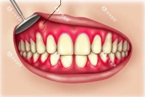 牙龈脓肿示意图 牙龈脓肿示意图