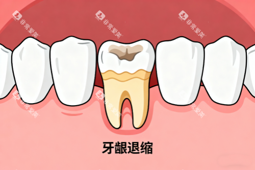 牙龈萎缩展示图 牙龈萎缩展示图
