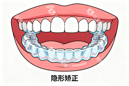 隐形矫正卡通展示图 隐形矫正卡通展示图