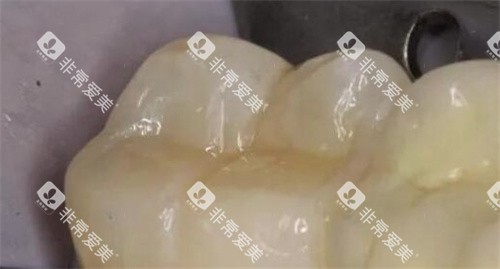 3M树脂补牙 3M树脂补牙