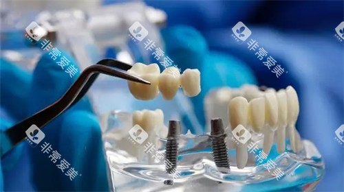 种植牙植体和牙冠安装模型示意图