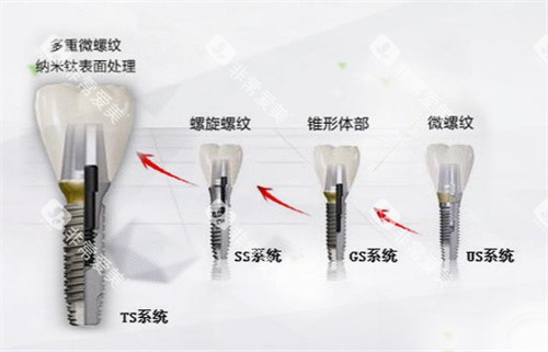 韩国奥齿泰种植体型号