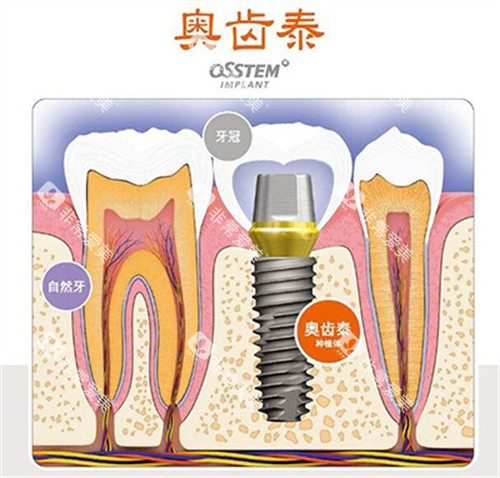 奥齿泰种植体材料展示