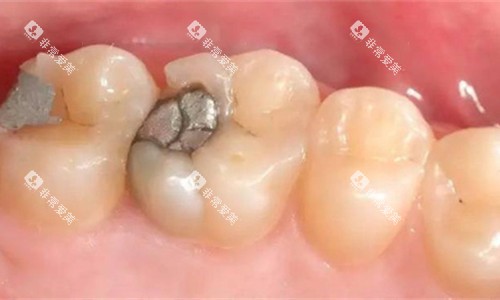 牙齿金属补牙图