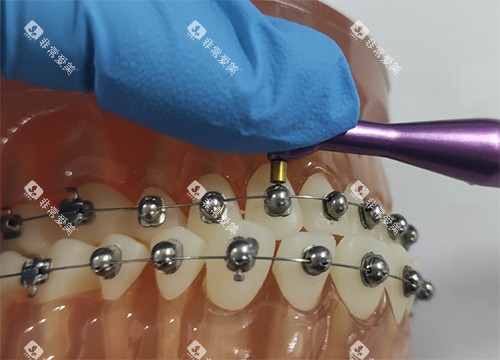 牙齿矫正OBrace球面托槽细节示意图