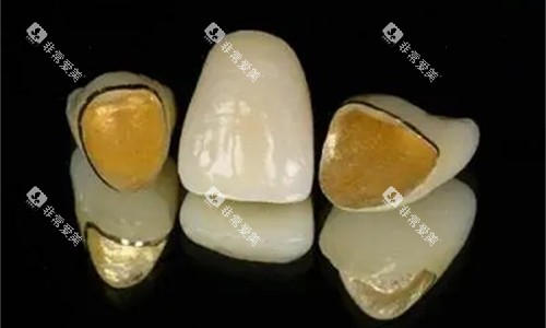 烤瓷牙金属内冠展示图