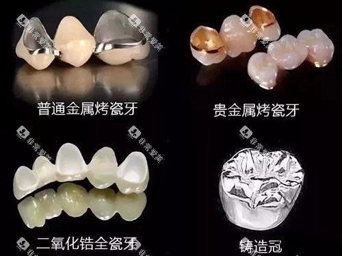 烤瓷牙的不同材质