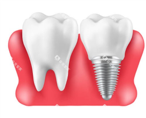 自然牙和种植牙